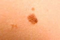 melanoma, anyajegyszűrés