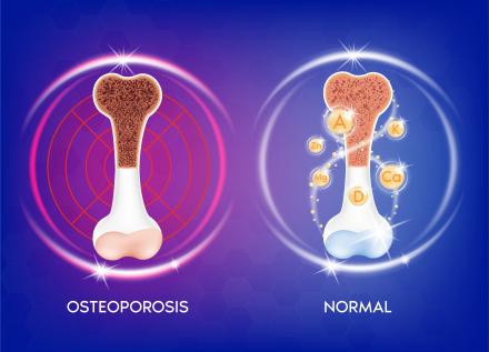 Osteoporosis